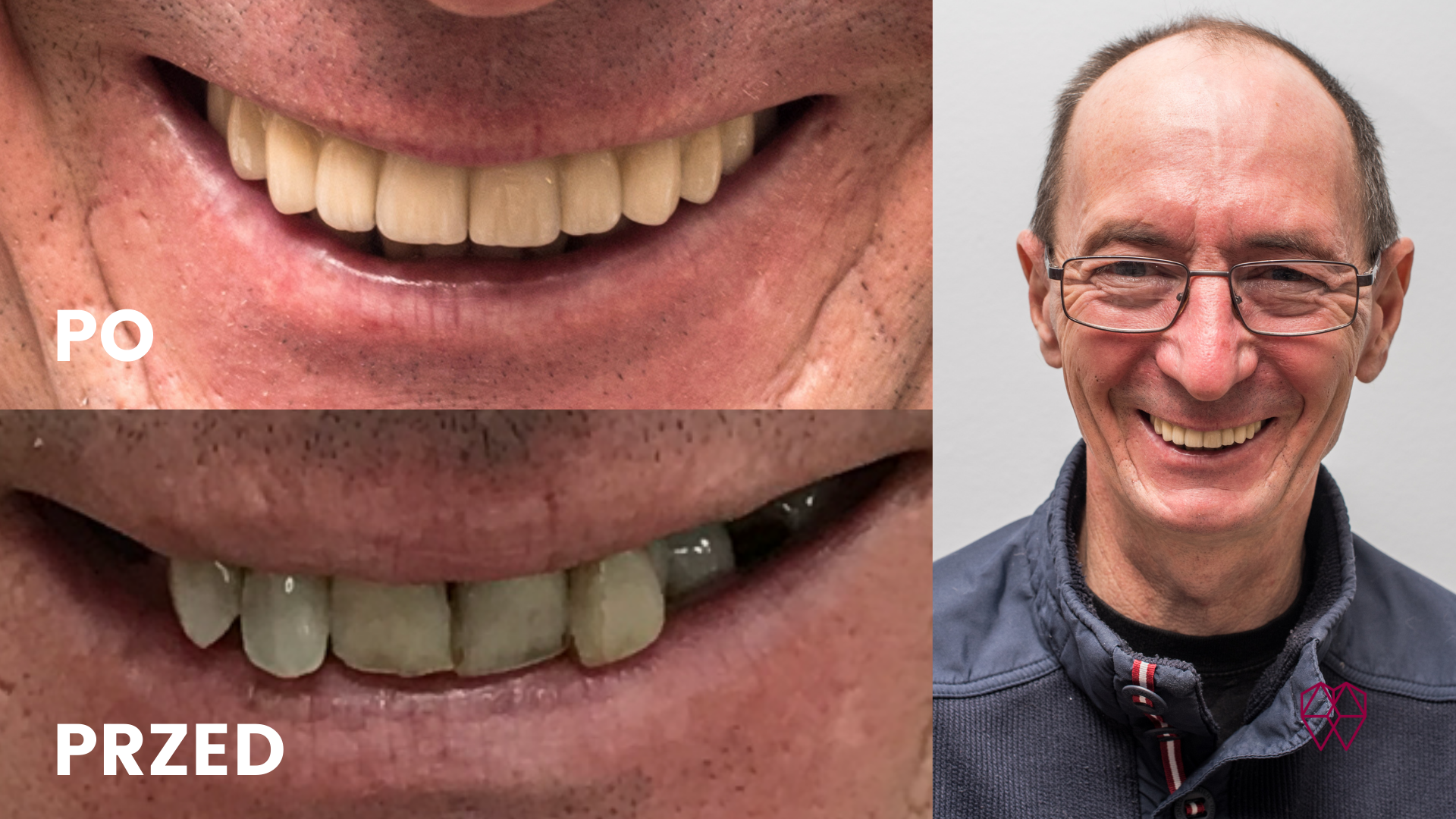 Implantolog pełnołukowy - metamorfoza